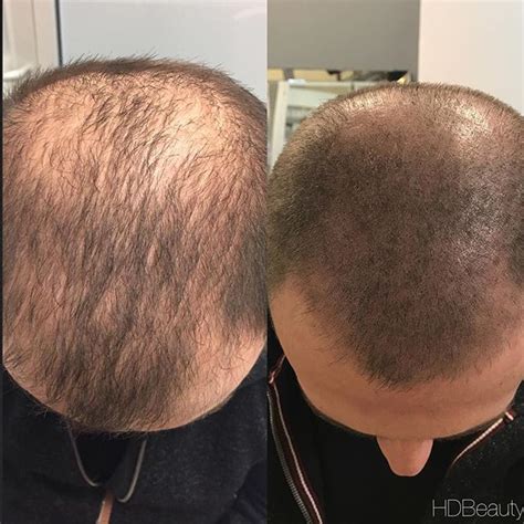 Everything You Need to Know About Scalp .
